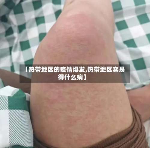 【热带地区的疫情爆发,热带地区容易得什么病】-第1张图片